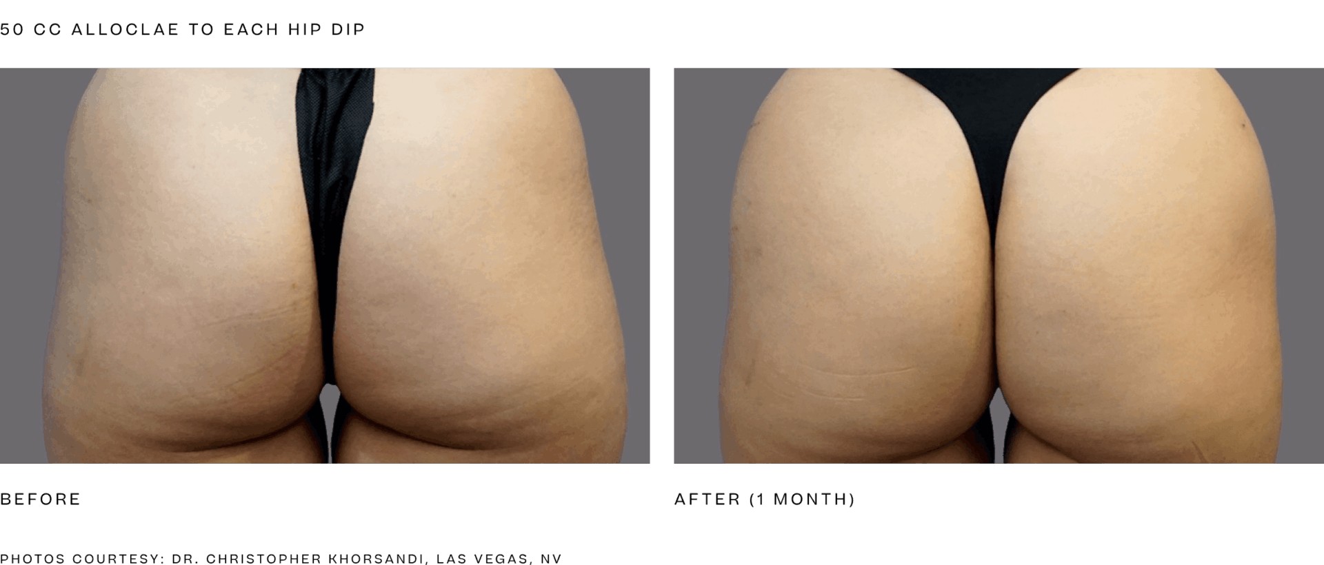 Alloclae before and after hip dip treatment, 50 cc to each hip dip, results at 1 month