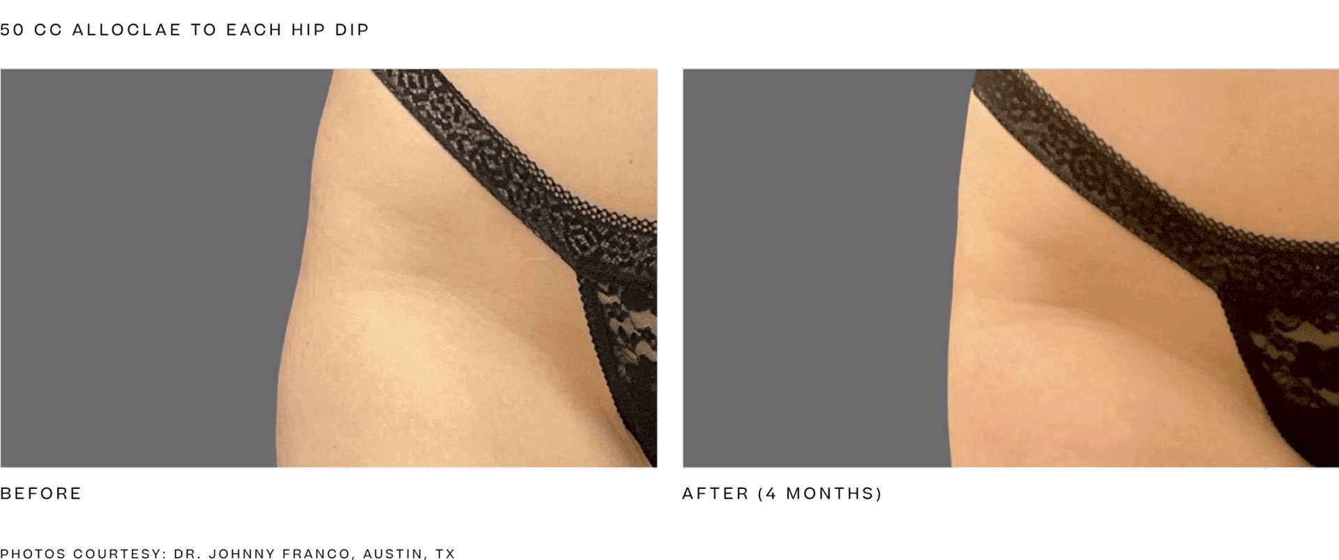 Alloclae before and after hip dip treatment, 50 cc to each hip dip, results at 4 months