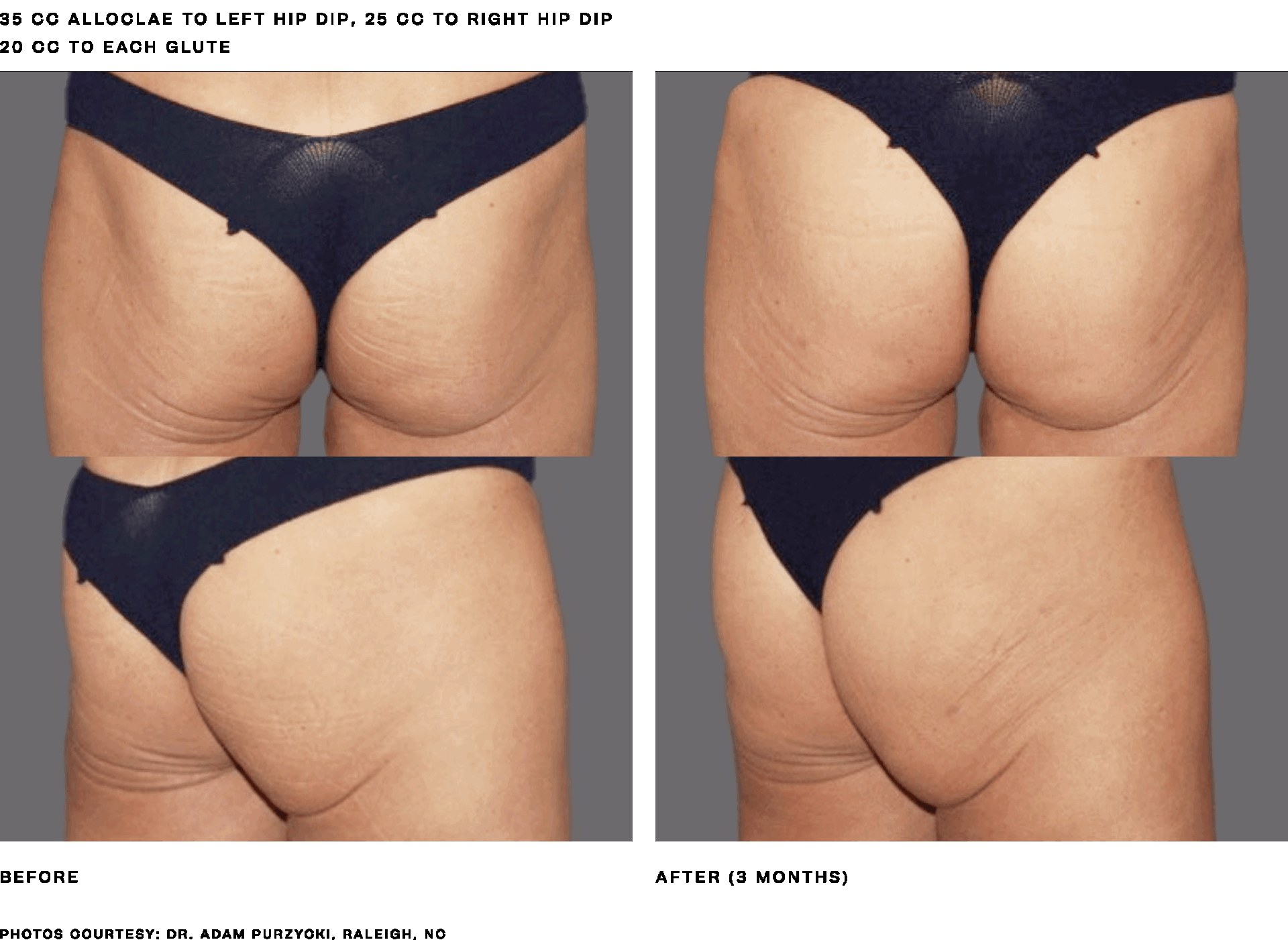 Alloclae before and after hip dip and glute treatment, 35 cc to left hip dip, 25 cc to right hip dip, 20 cc to each glute, results at 3 months