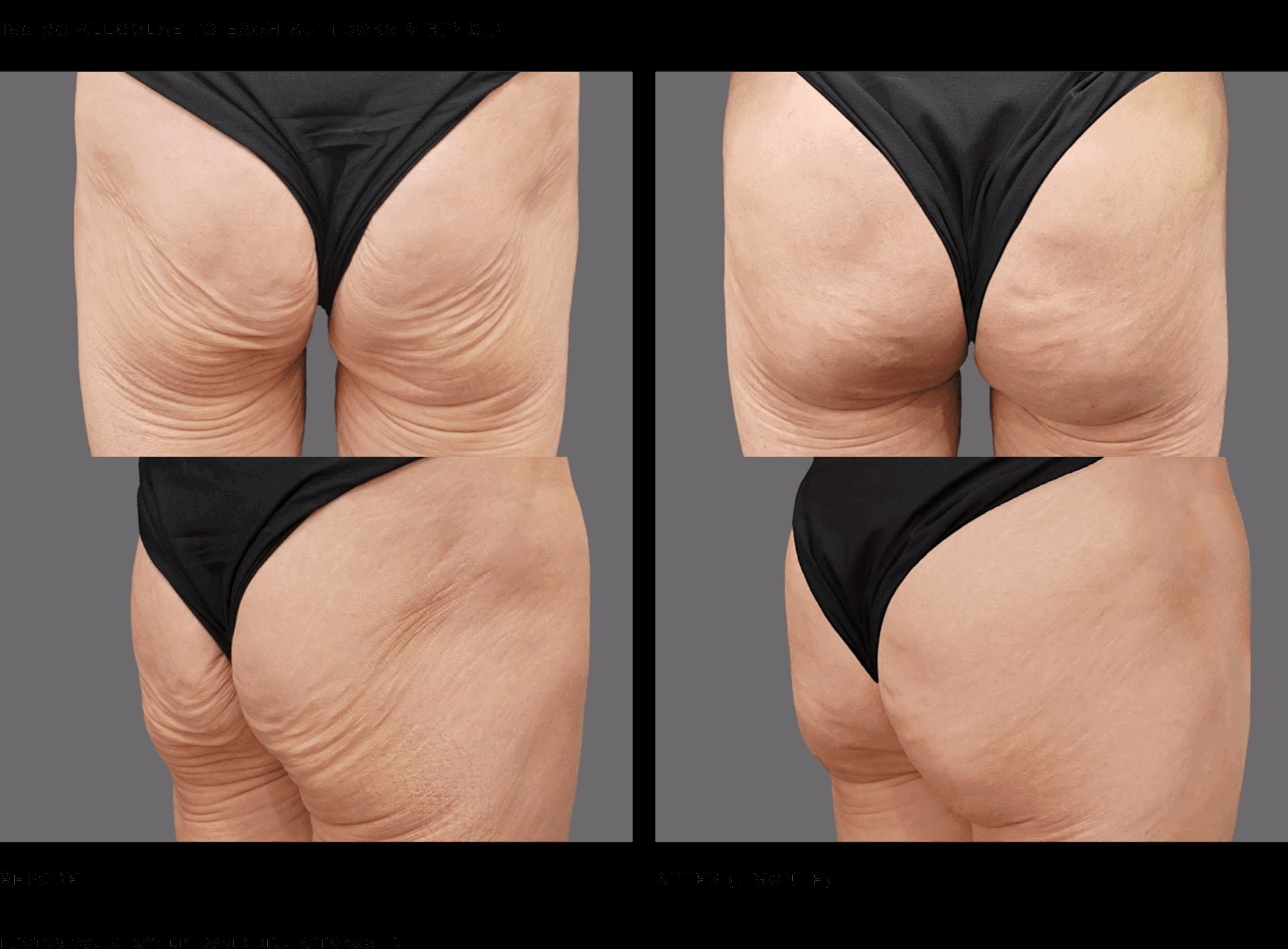 Alloclae before and after buttocks and hip dip treatment, 50 cc to each buttock and hip dip, results at 1 month