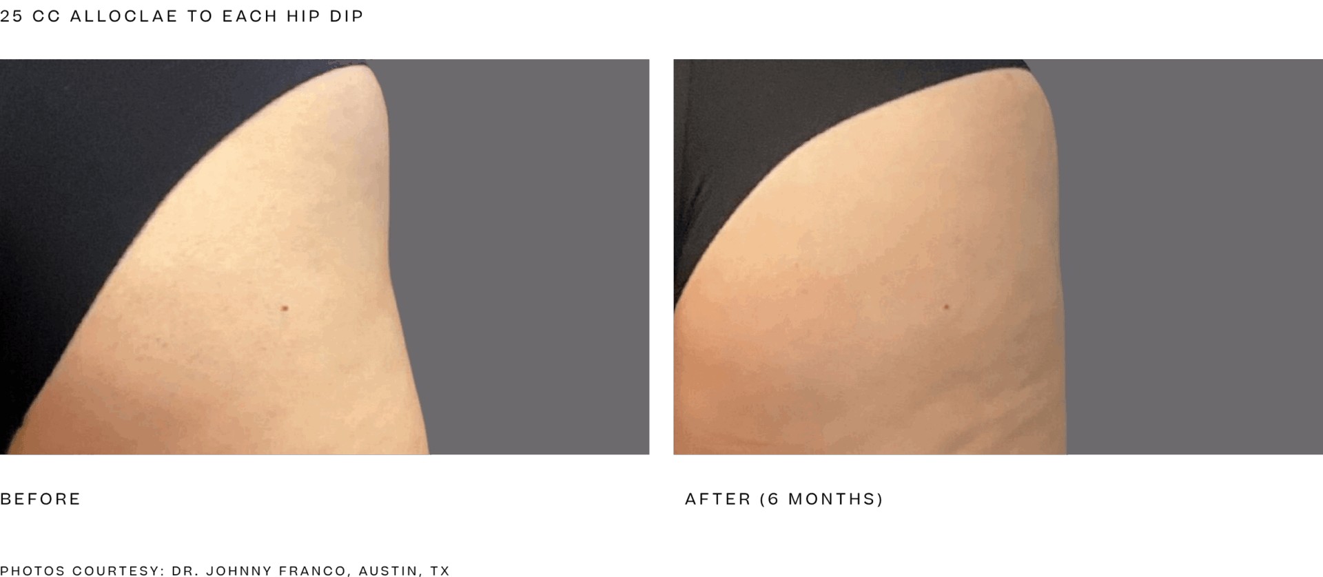 Alloclae before and after hip dip treatment, 25 cc to each hip dip, results at 6 months